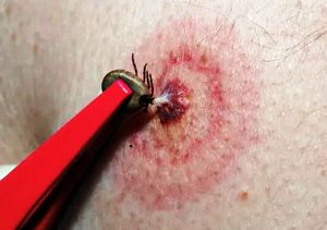 Círculos vermelhos no local da picada são alguns dos primeiros sintomas de Lyme. Segundo Ministério da Saúde, doença não é contraída no Brasil. Foto Reprodução