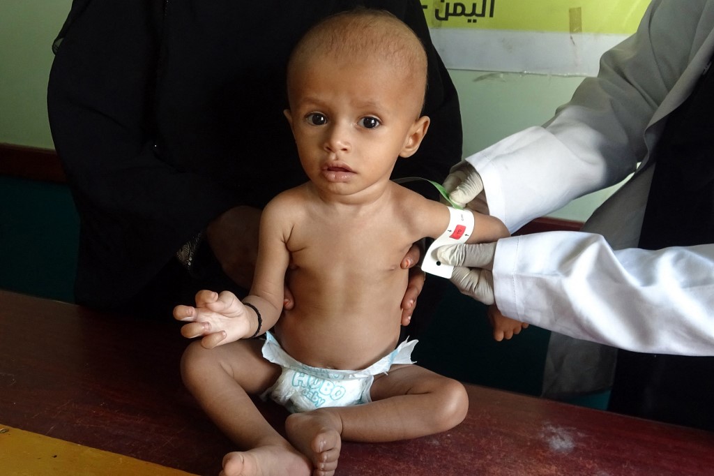 O pequeno iemenida Haiyan Saeed, de 18 meses de idade e 4 quilos de peso, numa clínica para desnutridos em Hodeida: crianças e mulheres são 73% dos deslocados pela guerra (Foto: Khaled Ziad / AFP - 06/11/21)