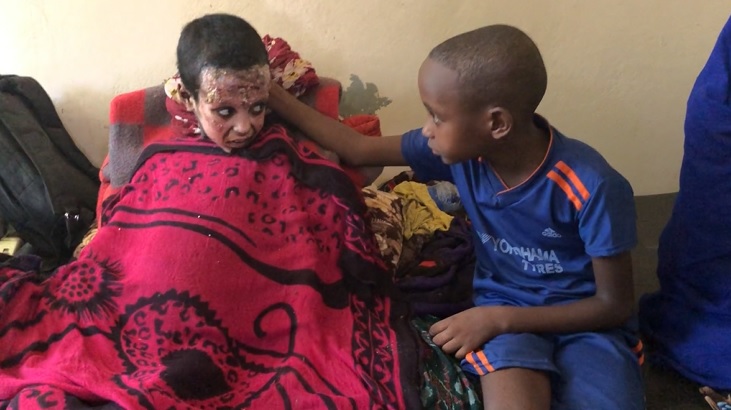 Irmãos com queimaduras no corpo se consolam em um hospital na capital da Etiópia. Foto Vinícius Assis