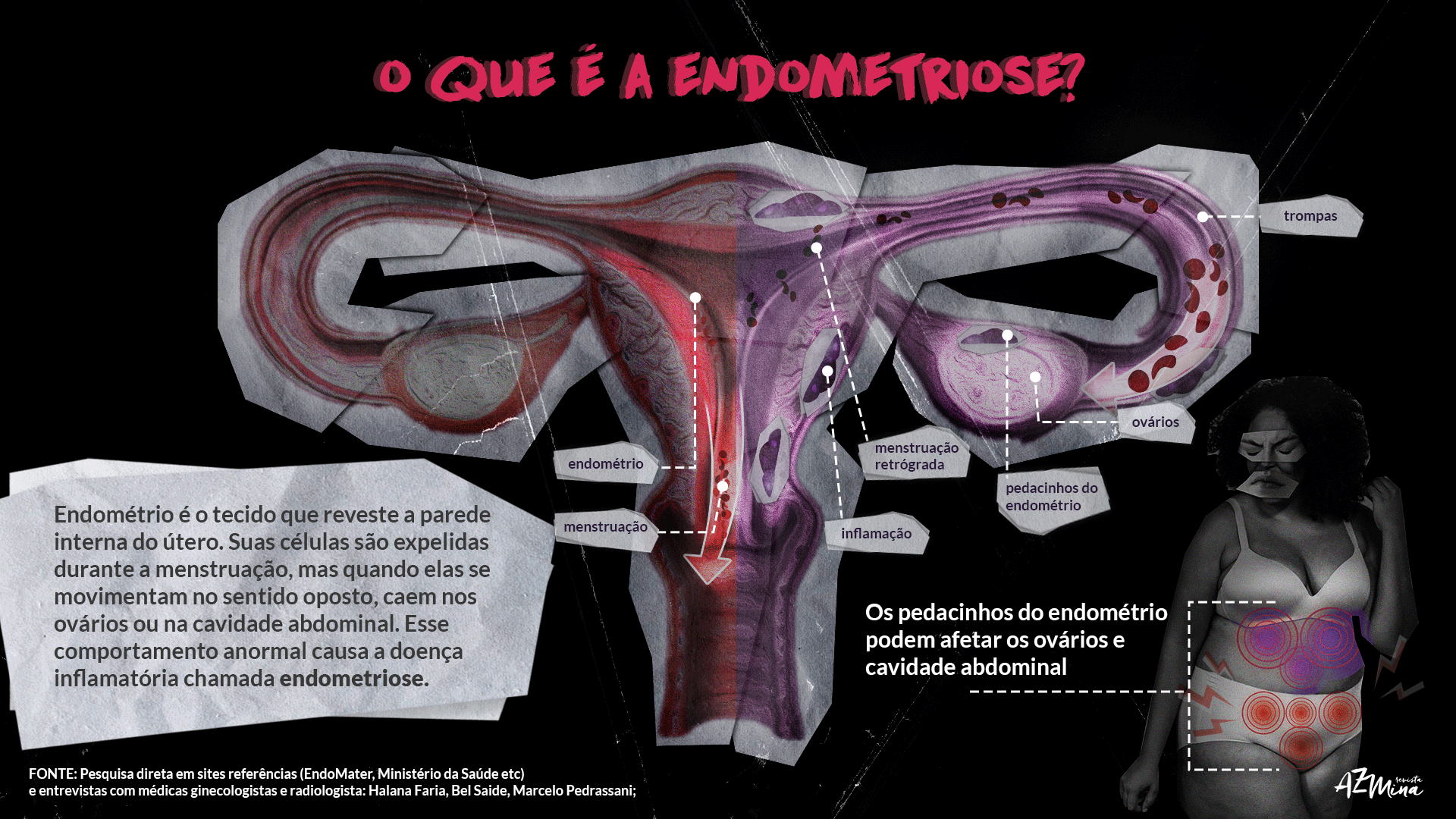 Endometriose e menstruação