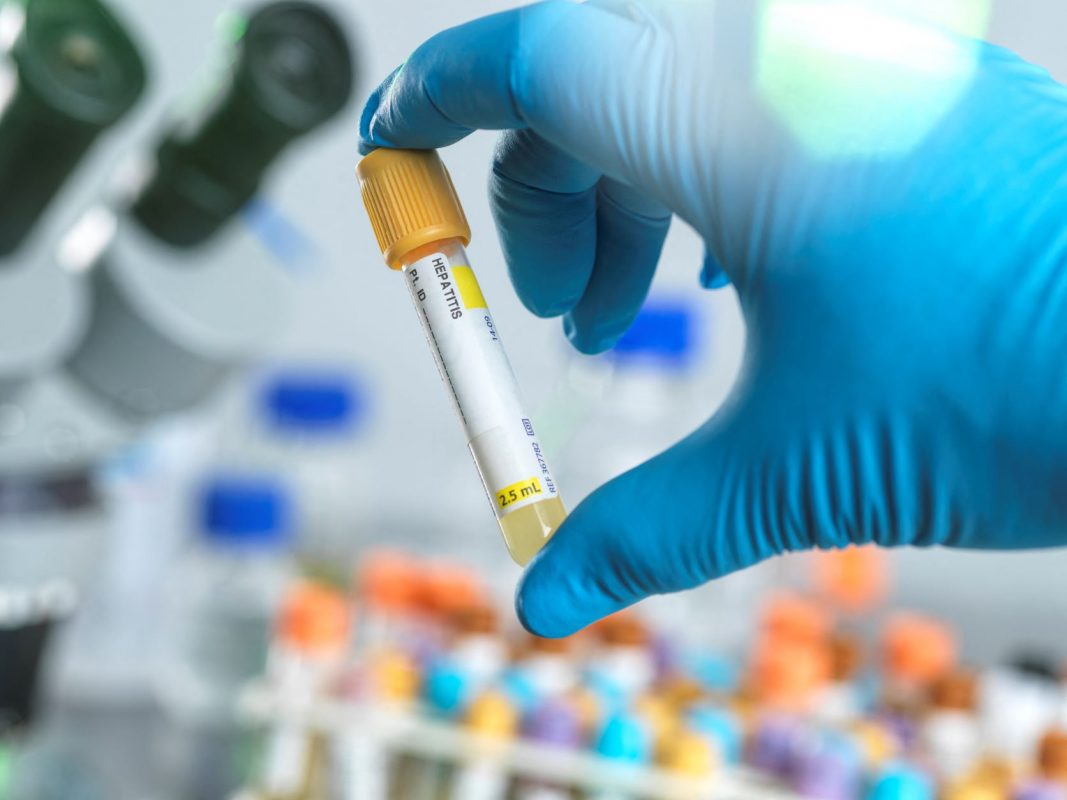 Técnico prepara teste para hepatite em laboratório: pesquisador da Fiocruz tira dúvidas sobre hepatite aguda grave em crianças (Foto: Science Photo Library / AFP)