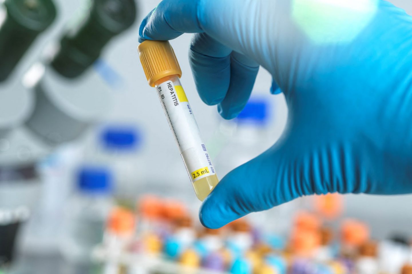 Técnico prepara teste para hepatite em laboratório: pesquisador da Fiocruz tira dúvidas sobre hepatite aguda grave em crianças (Foto: Science Photo Library / AFP)