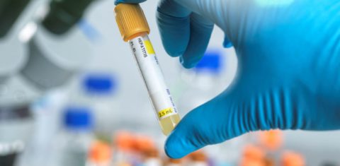 Técnico prepara teste para hepatite em laboratório: pesquisador da Fiocruz tira dúvidas sobre hepatite aguda grave em crianças (Foto: Science Photo Library / AFP)