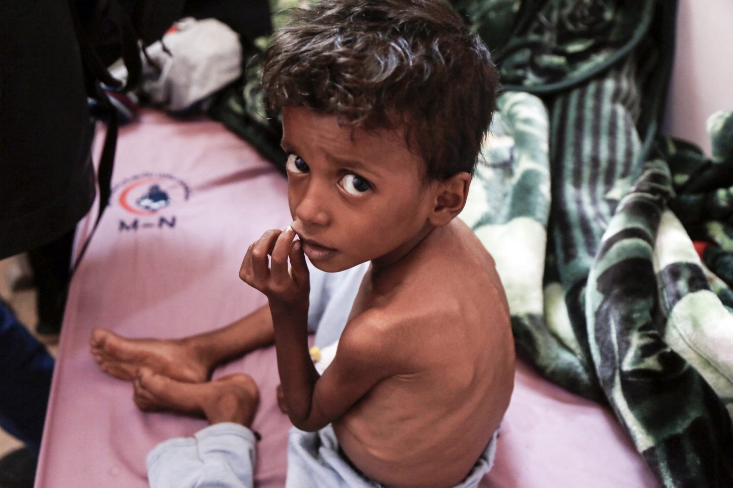 Criança com desnutrição recebe assistência médica no Hospital Materno Al Sabeen, no Iêmen. Subida recorde no preço dos alimentos deve aumentar a fome no mundo. Foto Mohammed Hamoud/Anadolu Agency