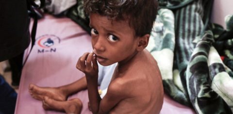 Criança com desnutrição recebe assistência médica no Hospital Materno Al Sabeen, no Iêmen. Subida recorde no preço dos alimentos deve aumentar a fome no mundo. Foto Mohammed Hamoud/Anadolu Agency