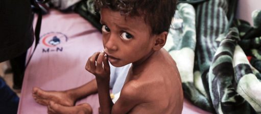 Criança com desnutrição recebe assistência médica no Hospital Materno Al Sabeen, no Iêmen. Subida recorde no preço dos alimentos deve aumentar a fome no mundo. Foto Mohammed Hamoud/Anadolu Agency