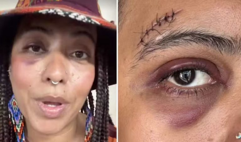As marcas do ataque misógino no rosto de Carla Lemos: agressão de desconhecido a influenciadora mostra que a violência de gênero não depende de vínculo, intimidade ou endereço compartilhado (Fotos: Reprodução / Instagram)